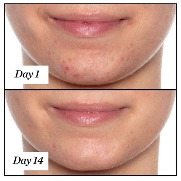 Sunday Riley U.F.O. Ultra-Clarifying Salicylic Acid Acne Treatment Face Oil - Picture 2 of 4